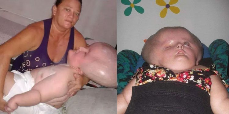 தலை மட்டும் பெரிதாக வளரும் அரிய நோயால் பாதிக்கப்பட்டுள்ள பெண்!