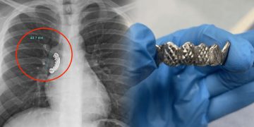 தொடர் இருமலால் பல்செட்டை தவறுதலாக விழுங்கிய நபர்!