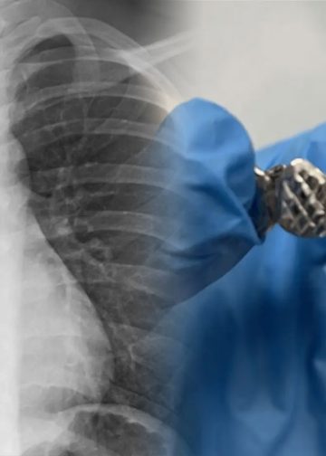 தொடர் இருமலால் பல்செட்டை தவறுதலாக விழுங்கிய நபர்!