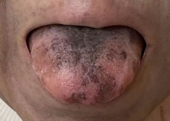 புற்றுநோய்க்கு சிகிச்சை எடுத்துக்கொண்ட பெண்ணின் நாக்கில் முளைத்த ரோமம்!