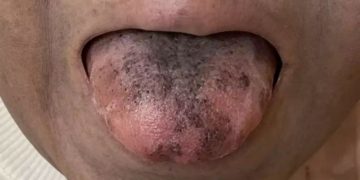 புற்றுநோய்க்கு சிகிச்சை எடுத்துக்கொண்ட பெண்ணின் நாக்கில் முளைத்த ரோமம்!