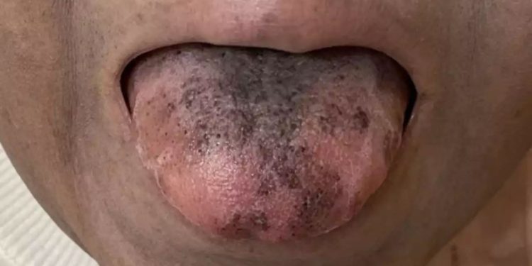 புற்றுநோய்க்கு சிகிச்சை எடுத்துக்கொண்ட பெண்ணின் நாக்கில் முளைத்த ரோமம்!